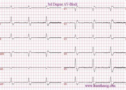 Üçüncü Derece AV Blok ve AV İleti sisteminde meydana gelen hasar sonucu oluşur ve atriyumlardan ventriküllere hiç uyarı geçmez.