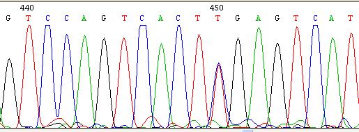 91 4.6.2. Aile L06 nın genetik laboratuvar uygulamalarının sonuçları Şekil 4-28 Aile L06 da etkilenmiş olgunun LIS1 geni dizi analizi sonucu LIS1 geninin 5.ekzonunda heterozigot p.