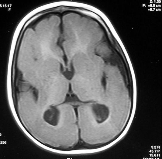 daha ağır etkilendiği klasik lizensefali (Grade 2) ile uyumlu bulundu.