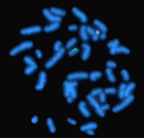 69 4.1.2. Aile L01 in genetik laboratuvar uygulamalarının sonuçları Şekil 4-4 Aile L01 deki etkilenmiş olgunun FISH analizi SMS/MDS/ILS özgün prob (Aquarius-Cytocell) ile yapılan FISH çalışmasında 17.