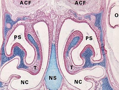 NC=nasal cavity NS=nasal septum PS=paranasal sinuses