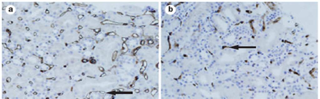 a)normal peritubuler kapiller b)