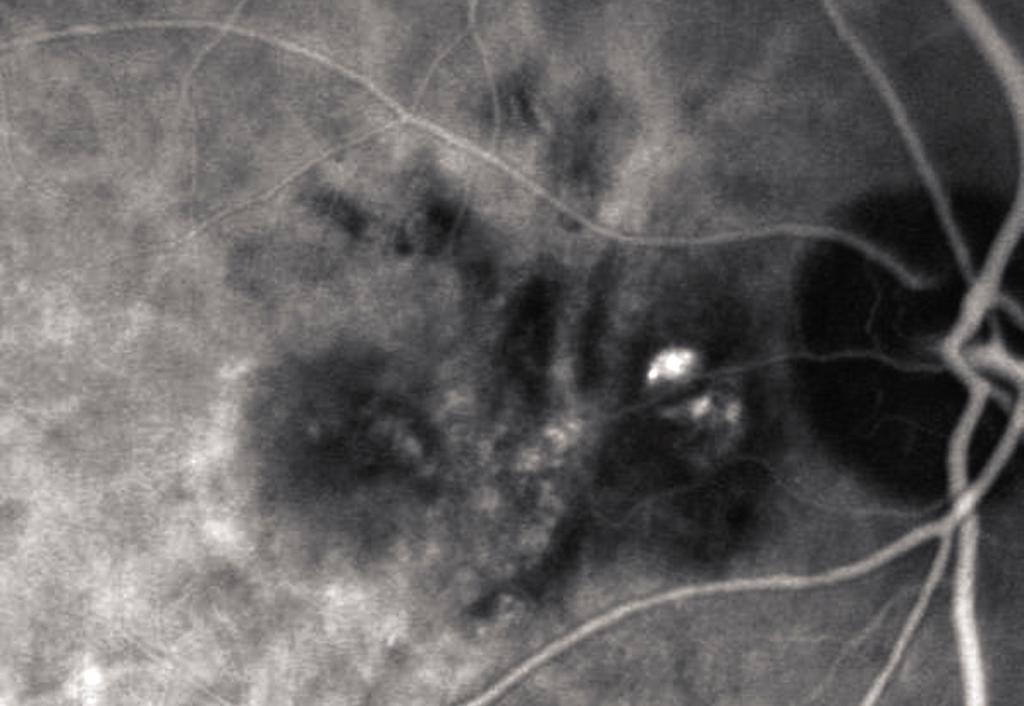 71 GİRİŞ Polipoidal koroidal vaskülopati (PKV), retinal anjiomatöz proliferasyon (RAP) ve büyük pigment epitel dekolmanı (PED) varlığı yaşa bağlı makula dejeneresanslı (YBMD) birçok olguda anti-vegf
