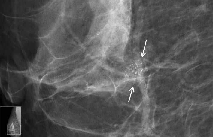 Sol meme invaziv duktal karsinom tanılı hastada dijital mamografide (a) düzensiz sınırlı kitle lezyonuna ait opasite ve bu düzeyde