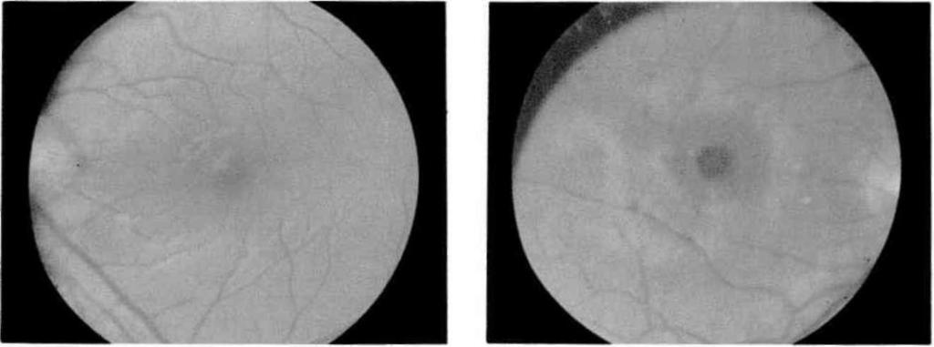 Kötü bir optik filtre ile güneş tutulmasının izlenmesi Dilate edilmiş pupilla İle güneşe bakma Teleskop ile yapılan güneş gözlemleri Bazı dini ayinler sırasında, ruh hastalıklarında ve halüsinasyon