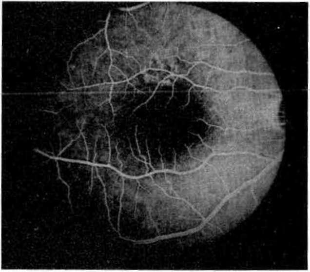 OFTALMOLOJİ HAZİRAN 1993 CİLT 2 SAYI 2 lensli veya göz içi lenssiz katarakt cerrahisinden, fakik gözlerdeki refraksiyon cerrahisinden ve vitreus cerrahisinden sonra bu tip makülopatiler görülebilir.