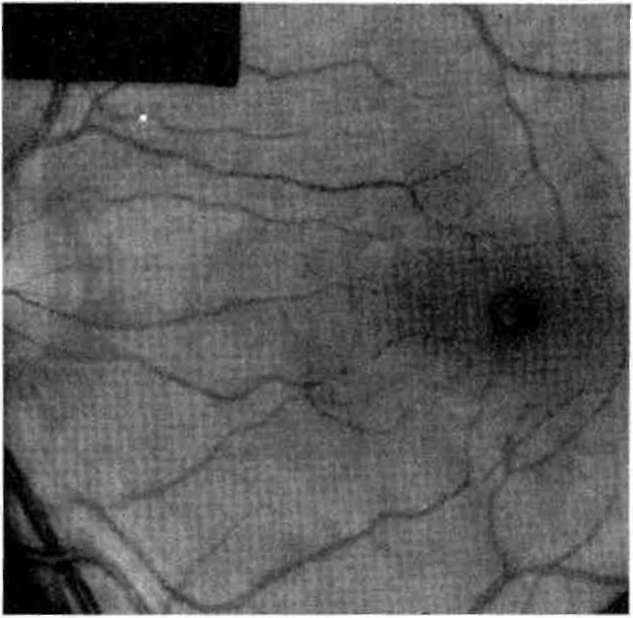 Bazen bu bölgenin üstünde, anjiografide yoğun olarak boyanan, seröz retina dekolmanı bulunur.