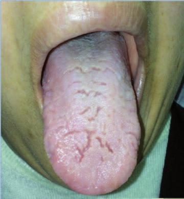 dır. Dilde fissür (plika linguata) ise olguların %30-40 ında görülmektedir. Semptomlar özellikle ilk ataklarda tedavisiz de gerileyebilmektedir. Fakat zamanla bulgular kalıcı olmaktadır.