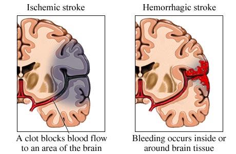 Epidemiyoloji Akut semptomatik perinatal inme Arteriyel