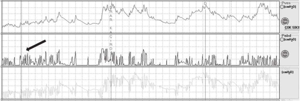 Şekil 4. Pves değerinde eşzamanlı artışa neden olmayan ve Pdet trasesinde negatif dalgalanmaya neden olan rektal hareketlilik.