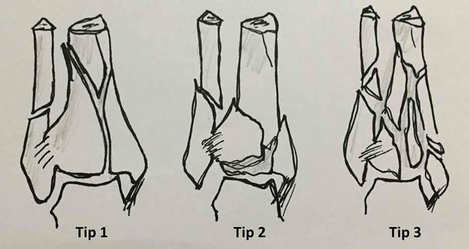 Tip 1, eklem uyumunun bozulmadığı, basit metafizyel ve eklem kırkları; Tip 2,