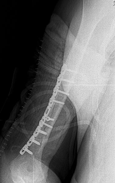 göstermektedir (1, 2). Humerus cisim kırıklarının birçoğu konservatif yöntemlerle başarı ile tedavi edilebilir. Tanımlanmış bir takım durumlarda cerrahi girişim düşünülebilir.