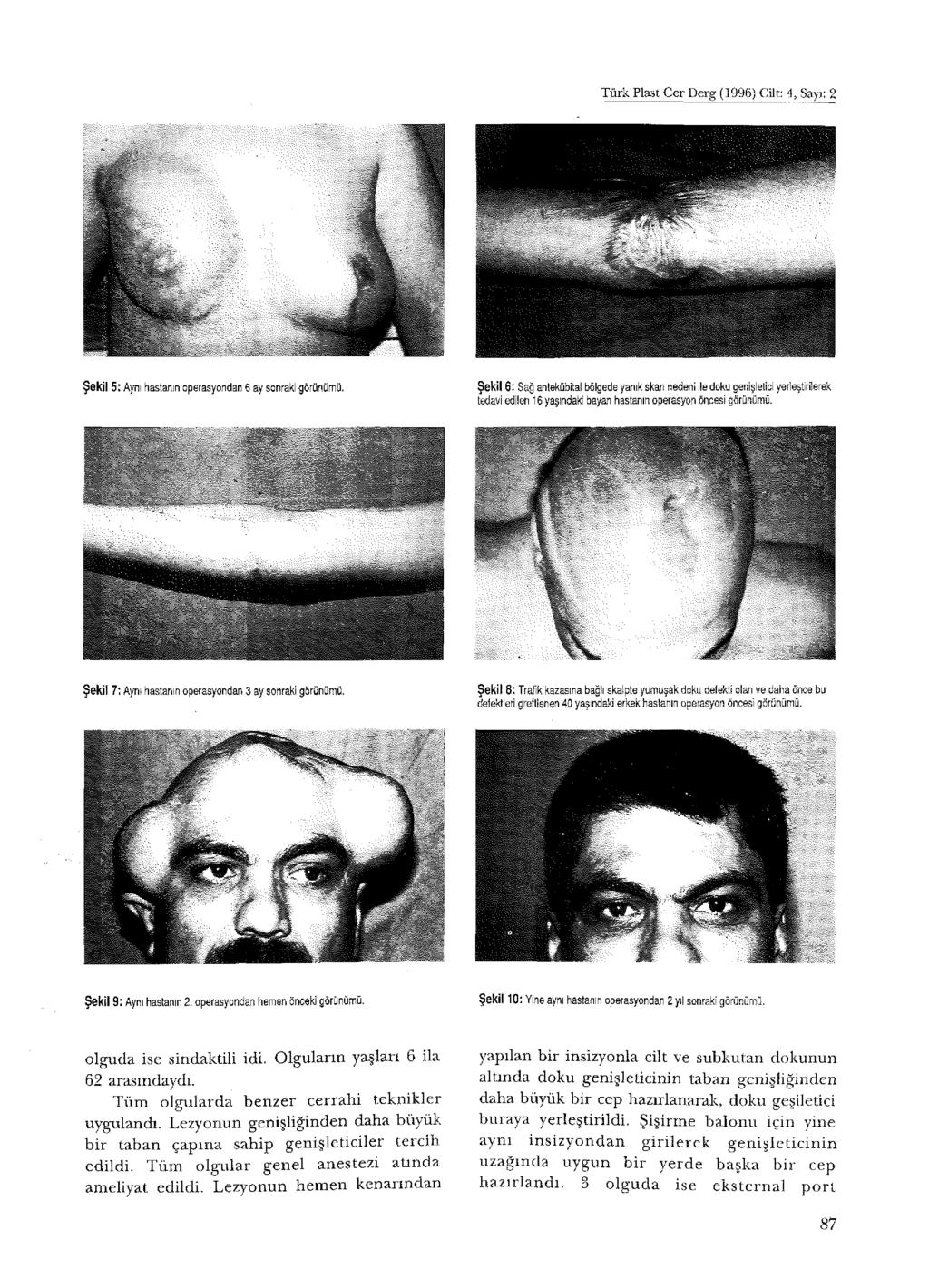 Türk Plast Cer Derg (1996) Cilt: -4, Sayı: 2 Şekil 5 : Aynı hastanın operasyondan 6 ay sonraki görünümü.