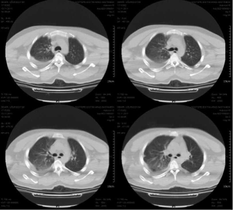 General Surgery Özemir et al. RESİM 3: Preoperatif Toraks BT'de sağ hemitoraksta hemotoraks görünümü.