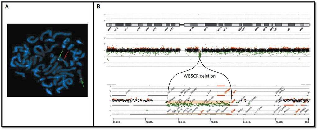 35 e) Bromodomain ile bitişik zinc-finger protein 1B geni (BAZ1B): Bu gen delesyonunun hiperkalsemi ve intrakardiyak malformasyonlarla ilişkili olabileceği fare kaynaklı çalışmalarda gösterilmiştir