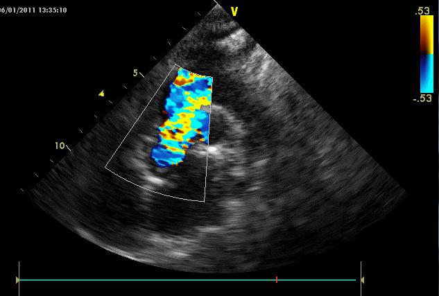 Özellikle SVAS olan olgularda aort kökü ve sinotubuler bileşke görülerek Doppler
