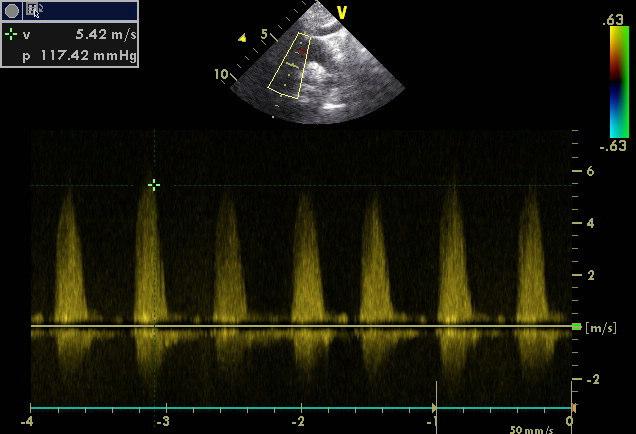 Supravalvar aort darlığı olan bir hastada iki boyutlu (a), renkli EKO (b) ve