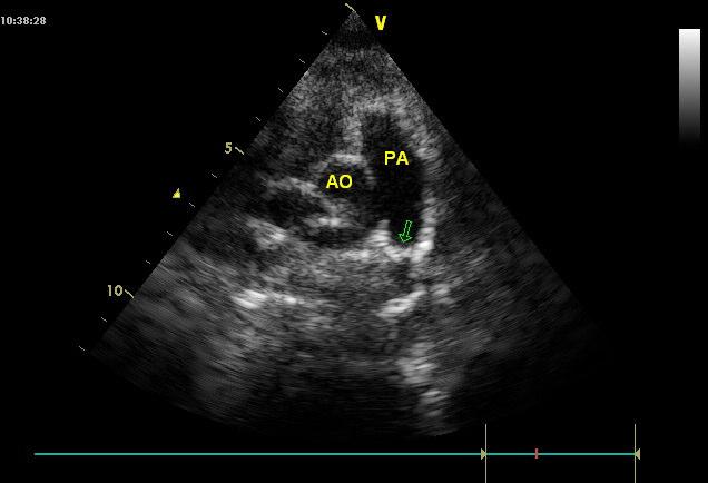 42 Supravalvar bölgede darlığı olan hastalarda, darlığın ciddiyeti belirlenirken valvüler aort darlığında olduğu gibi derecelendirme yapıldı.