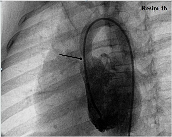 57 6. Kalp kateterizasyonu bulguları: Williams sendromlu hastalarda kardiyak anatomiyi daha iyi görmek, hemodinamik değerlendirme yapabilmek, koroner arterlerin durumunu görmek ve girişimsel amaçlı