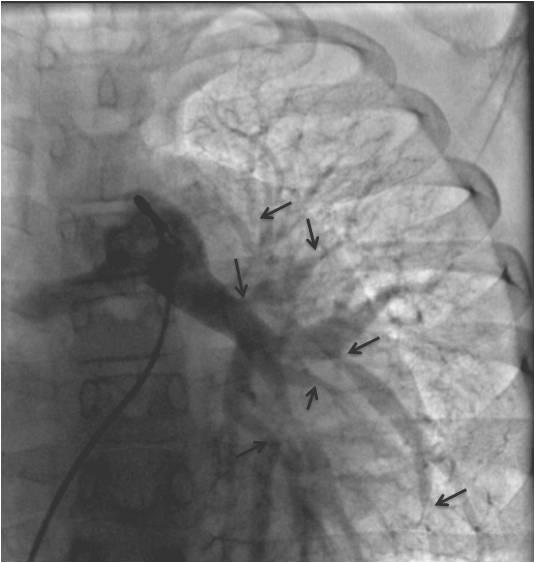 görüntülemesinde (a); diffüz darlık-hipoplazi görülürken, sol pulmoner arter görüntülemesinde (b) çok sayıda dar segmentler ve poststenotik genişlemeler görülmektedir (İstanbul Üniversitesi, İstanbul