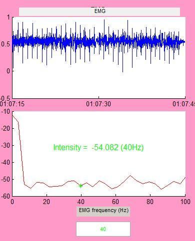 28 EMG sinyalinin istenilen zaman aralığında Welch yöntemi ile 0-150 Hz frekans aralığında güç spektral yoğunlukları bulunmuştur. Şekil 4.4 te örnek işlenmiş EMG sinyali görülmektedir.
