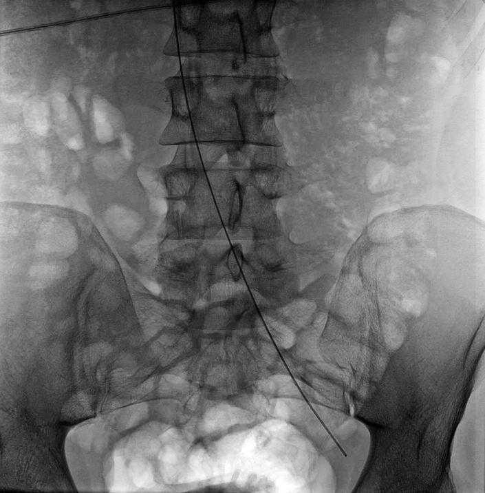 OLGU SUNUMLARI OLGU 1 Yirmi beş yaşında erkek hasta, dış merkezde gerçekleştirilen sol vena safena magnaya yönelik endovenöz lazer ablasyon tedavisinden yaklaşık 10 gün sonra boynunun sağ tarafında