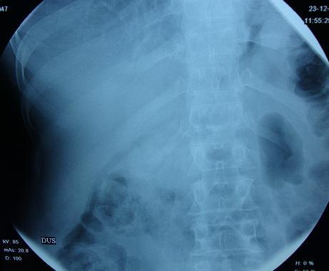 Diyafram, istenen radyografi bölgesini içine alacak Ģekilde FFM 100 cm, Kv ve mas değerleri hastanın yaģına ve kilosuna göre ayarlanır.