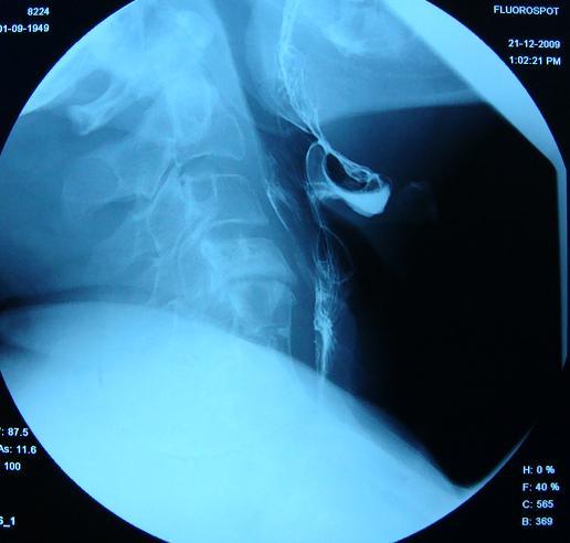 radyogramı Sol lateral üst mukoza spot, sol lateral