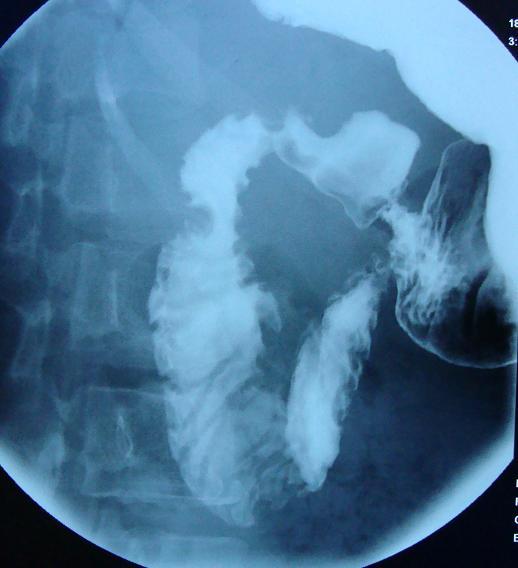 Sol oblik pozisyon verilerek spot radyogram alınır. Bu radyogramda boģ duodenal bulbus görülür.