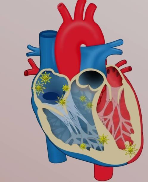 sinüs nodun fazla çalışması Atrial hücrelerden giderek artan