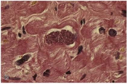Toksoplazmoz Tanı Histopatoloji Kas Frenkel Toxoplasmosis In: Pathology of Infectious Disease