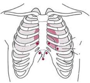 man varsa hekim steril giyinmelidir. Hasta, üst gövdesi 30-45 derece kalkık olacak şekilde sırtüstü yatırılır. Böylece, kalp göğüs ön duvarına yaklaşır ve sıvı kalbin alt yüzüne toplanır.