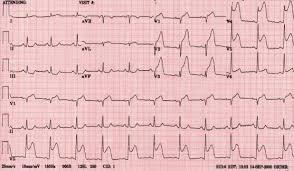 arresmn nedeni Aile hikayesi EKG EKG Pulse oksimetri