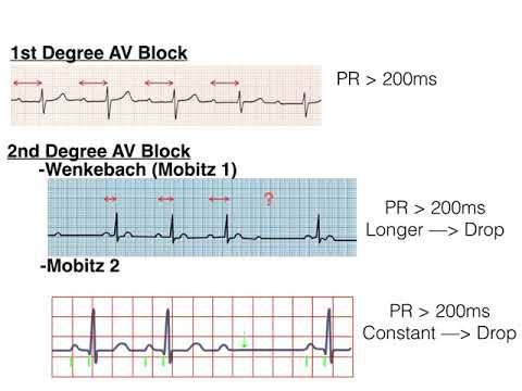 EKG Hız Ritim : Normal (60-100/dakika) : Düzenli P dalgası :