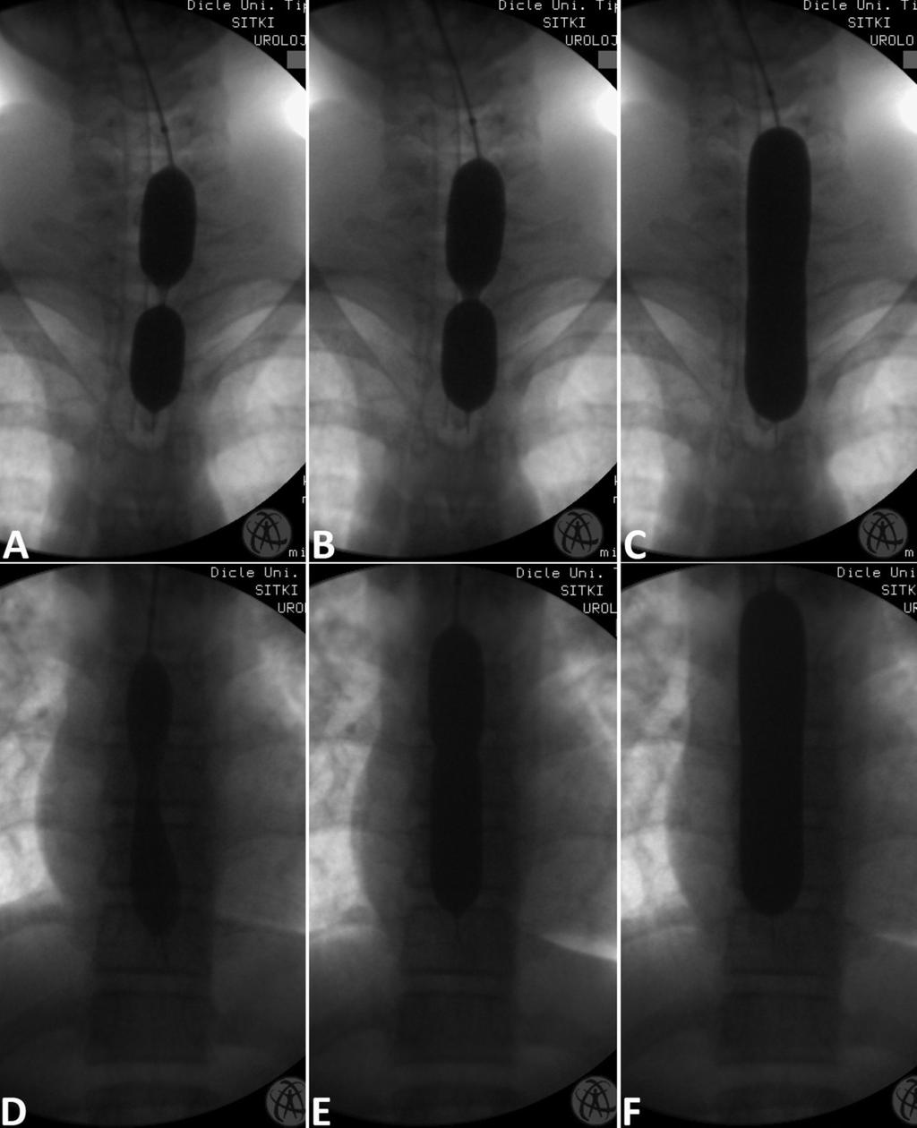 RESİM 3: Yağ çözücü (Resim 1 E) içmiş 14 yaşındaki hastanın üst (A, B, C) ve orta (D, E, F) özofagustaki darlıklarının floroskopi eşliğinde geniş balon (The Controlled Radial Expansion, CRE, 8 cm,