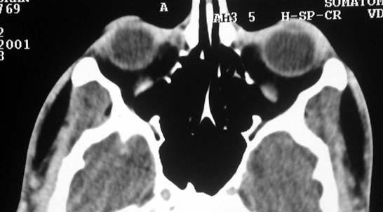 Scwannoma