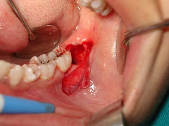 Daha sonra standart cerrahi yöntemler kullanılarak yarı gömülü 3M diş çekilmiştir (Resim4).