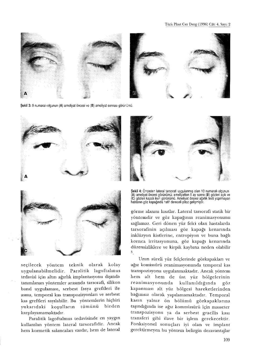 Türk Plast Cer Derg (1996) Cilt: 4, Sayı: 2 Şekil 4: Önceden lateral tarsorafi uygulanmış olan 10 numaralı olgunun (A) ameliyat öncesi görünümü; ameliyattan 5 ay sonra (8) gözleri açık ve (C) gözleri