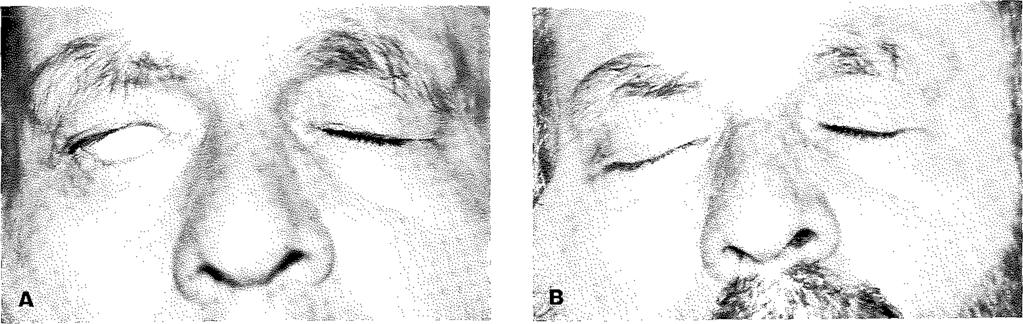 Şekil 6:14 numaralı olgunun (A) ameliyat öncesi görünümü; ameliyattan 3 ay sonra (B) gözleri açık ve (C) gözleri kapalı görünümü.