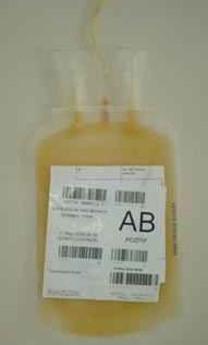 Bu yöntemle bir ünite trombosit süspansiyonu elde edilir; geri kalan kan ise bir baģka hastanın ihtiyacı için kullanılır.
