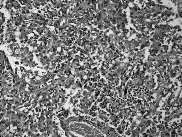 hücreli karsinom Bellini toplayıcı kanal karsinomu Renal meduller karsinom Xp11 translokasyon karsinomu Nöroblastom sonrası gelişen karsinom Müsinöz tübüler ve iğsi hücreli karsinom