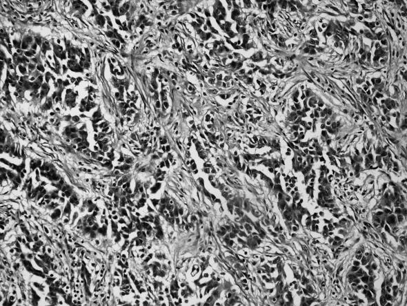 x200). Şekil 4. Medullada yerleşimli, mikroskopik incelemede desmoplastik stromada belirgin hücresel atipi gösteren tübüler yapılardan oluşan toplayıcı kanal karsinomu izlenmektedir(h-e x200).