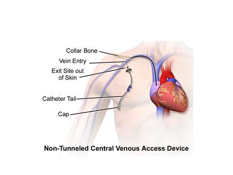 Tünelsiz SVK İnternal juguler/subklavian ven veya femoral ven Distal