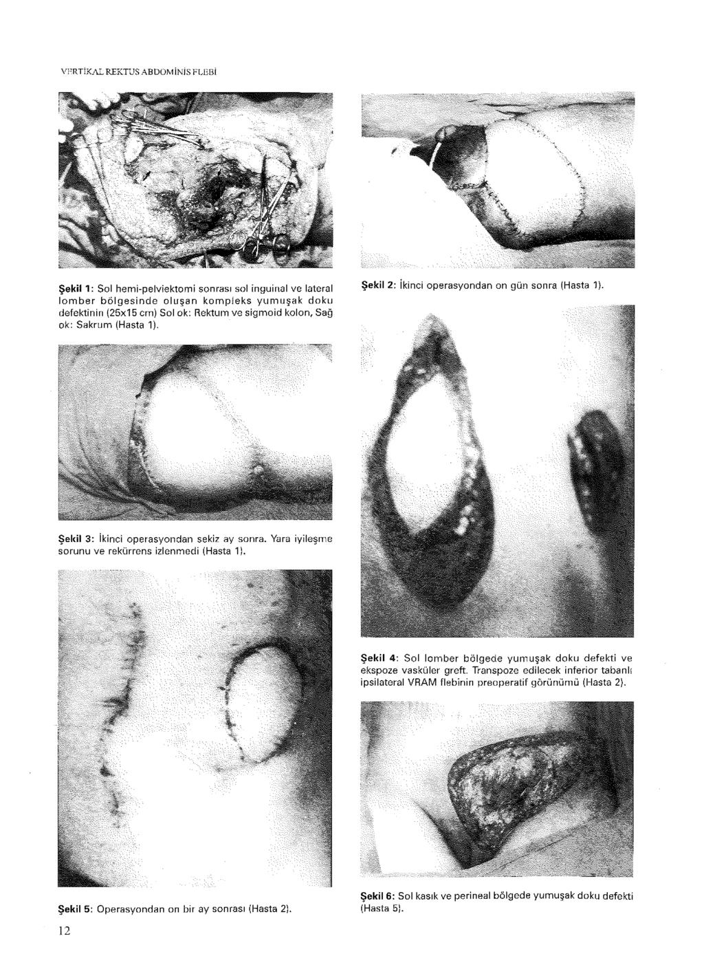 VERTİKAL REKTUS ABDOMİNİS FLEBİ Şekil 1: Sol