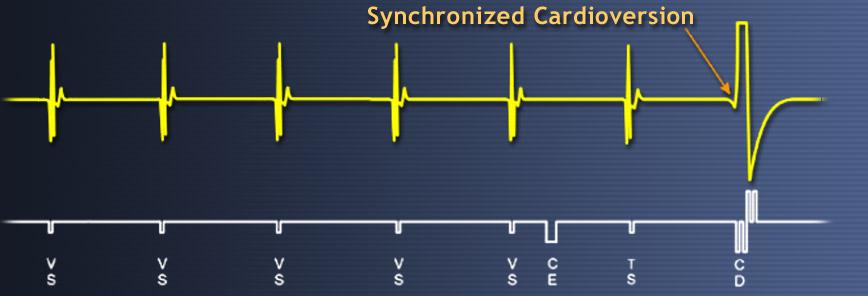 Kardiyoversiyon l Şok R dalgası üzerine uygulanır l Aritmi sonlanması