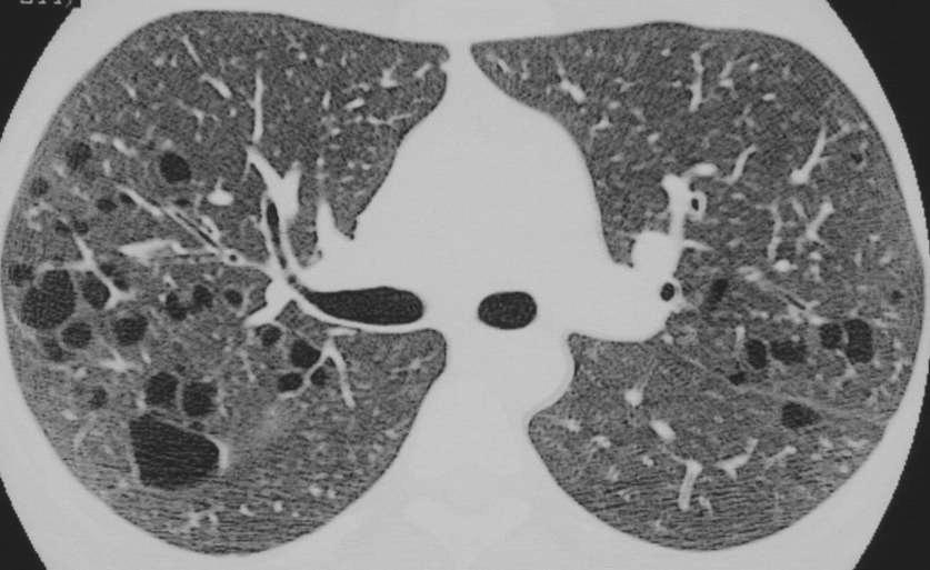 Kistik patern Genel Bilgiler Histiyositoziste, LAM, postinfektif pnömotosel,