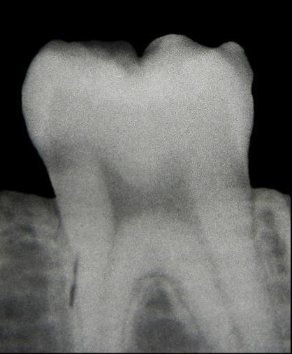 Şekil 43: x ışını ile diş radyogramının radyolojik görüntüsü Şekil 44: x ışını ile diş radyogramının atomik görüntüsü Dental görüntülemede yöntemler ağız içi ve ağız dışı olarak ikiye