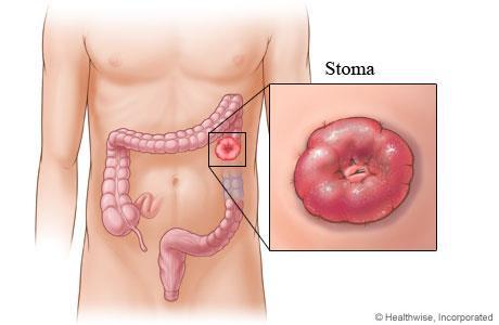 STOMA-OSTOMİ Yunanca dan gelen bir