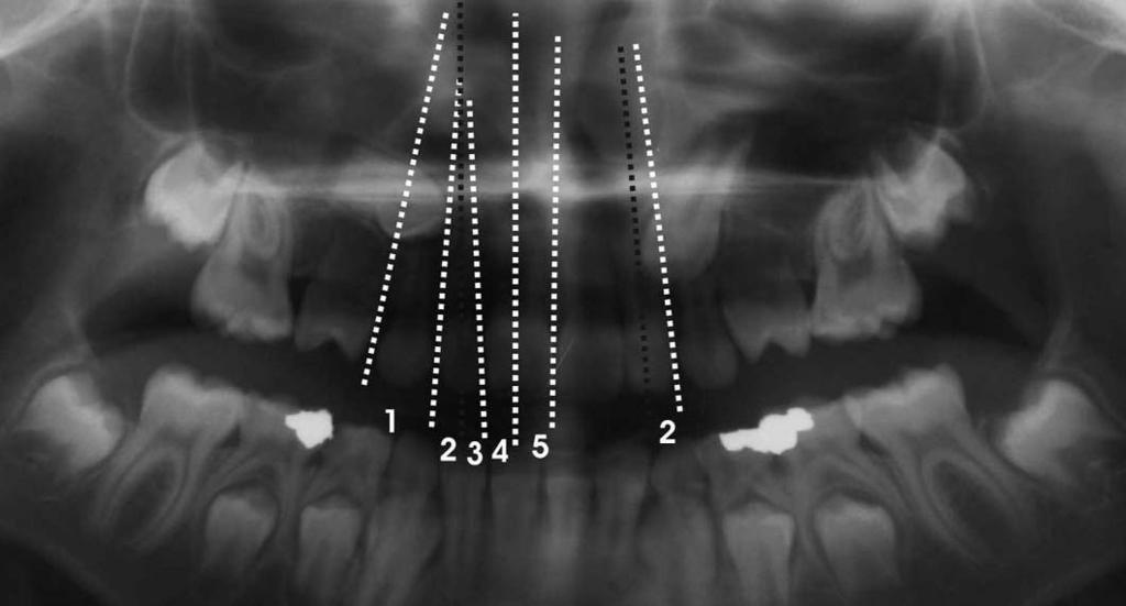 Ramo lu, leri, Göyenç fiekil 4. Ericson ve Kurol ün (4) tarifine göre konumsal de erlendirmeler için panoramik röntgen üzerinde oluflturulan bölgeler.
