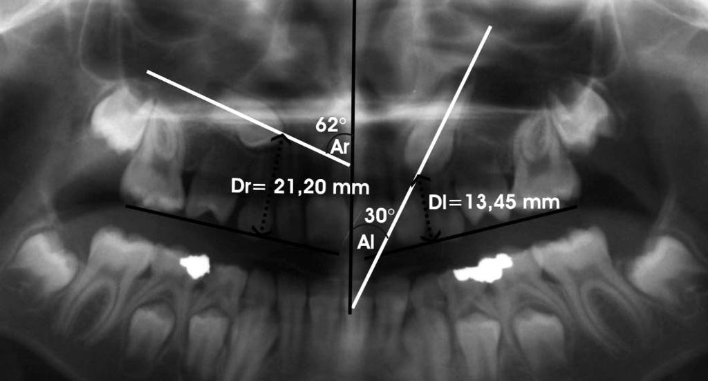 Sectors constructed for positional evaluation on panoramic radiographs according to description of Ericson and Kurol (4).